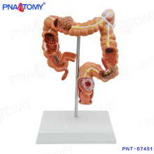 PNT-07451 Modèle intestinal humain Maladie Modèle Large Intestines pour l&#39;éducation